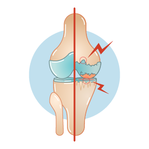 Osteoarthritis